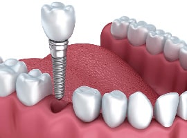 Cấy Ghép Răng (Implant)