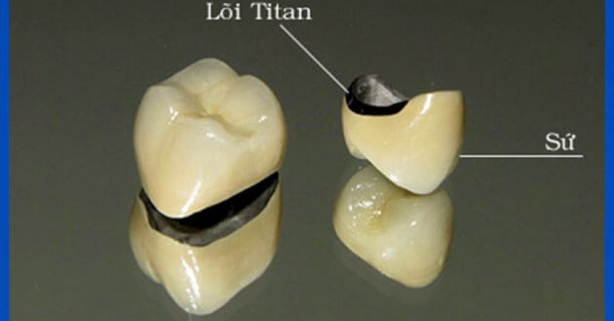 Răng sứ titan
